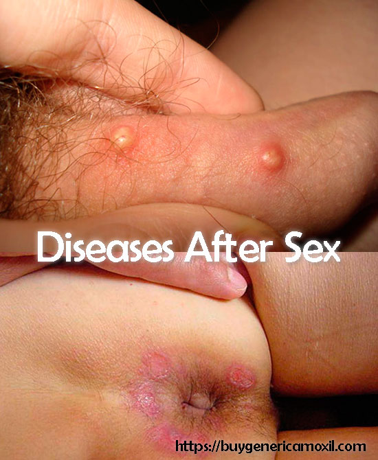 diseases after sex